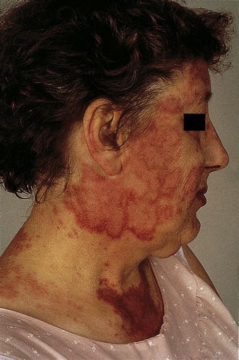 Skin Manifestations Of Systemic Disease Medicine