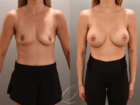 Breast Augmentation Before After Photos Patient 1001559 Serving