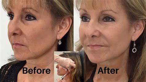 How To Get Rid Of Jowls With Dermal Fillers Step 2 Youtube