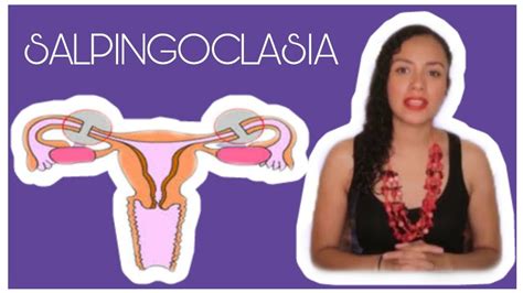 Salpingoclasia EsterilizaciÓn Femenina Otb Cuidados ¿es Reversible