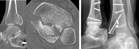 Multifragmentary Tibial Pilon Fractures: Midterm Results ...