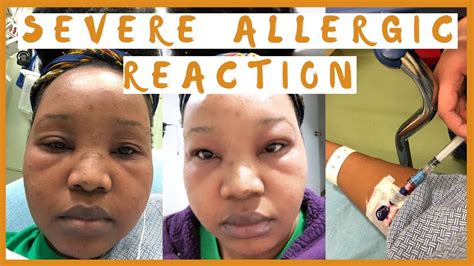 Severe Allergic Reaction😢 Youtube