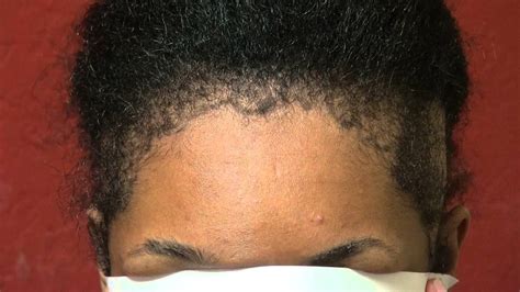 Most people can manage their hairline, and there are some treatments available that can. Bay Area Black Female Receding Hairline Transplant ...