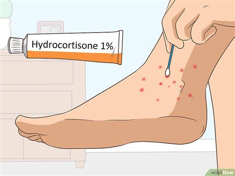 Apply antiseptic to bitten areas. 3 formas de curar las picaduras de ácaros rojos