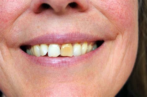 What Causes Tooth Discoloration