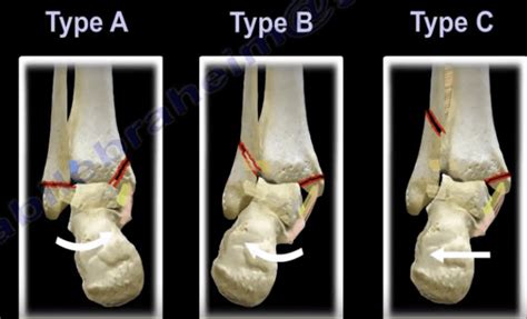 Ankle Fractures Danis Weber Classification Nabil Ebraheim MD Orthopedic Surgeon