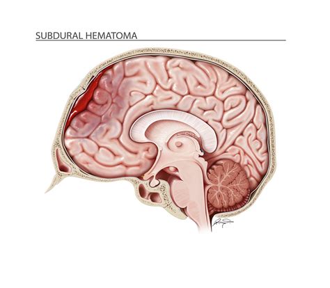 Subdural Hematoma On Behance