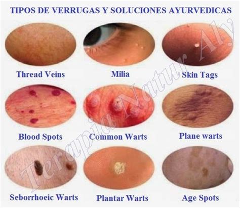 Lista Foto Im Genes De Verrugas Del Papiloma Humano Alta Definici N