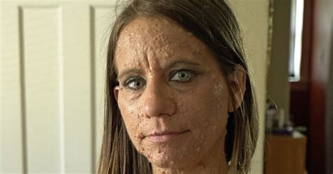 Rare Skin Disease Leaves Woman Covered In Almost 6000 Tumours