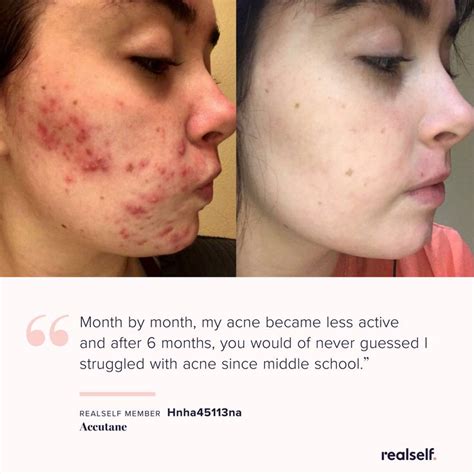 Accutane Side Effects Uses Results And More Realself Acne Treatment Accutane Topical