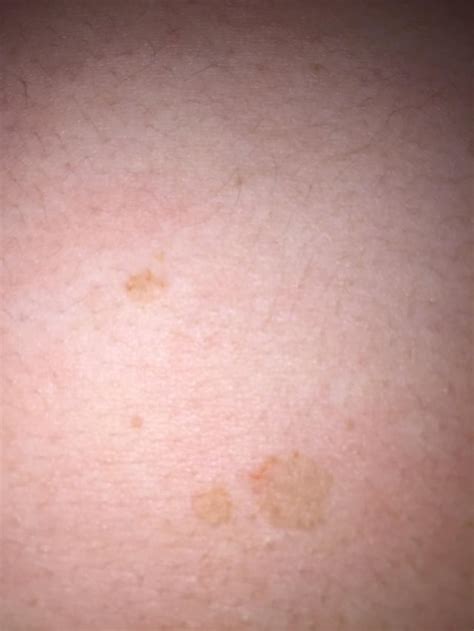 Brown Spots On Chest