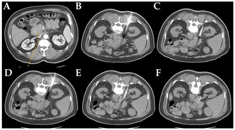 Jcm Free Full Text Percutaneous Computed Tomography Guided Coaxial