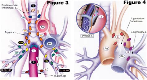 Lung Cancer Lymph Nodes