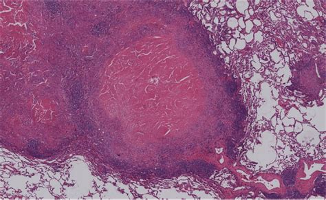 Hande Lung Granulomatous Chronic Inflammation With Caseous Central