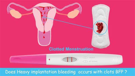 Heavy Implantation Bleeding With Clots Stories With Pictures
