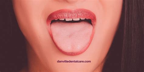 Salivary Gland Stones What Are They And How Are They Treated