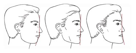 Indicators And Preferences Of Facial Profile And Aesthetics