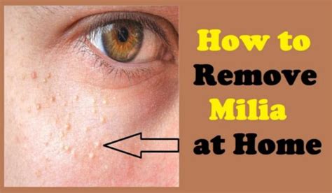 How To Get Rid Of Milia At Home Easily Right Home Remedies