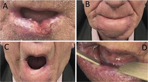 Near Totaltotal Lower Lip Reconstruction—chin Rotation Advancement Flap Amin Abu Jabal