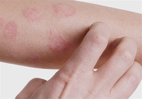 Dermatite O Que Sintomas Tipos Da Doen A E Como Tratar