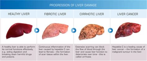 1progression Of Liver Damage