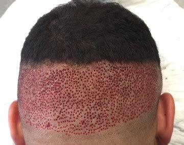 It's a type of surgery that moves hair you already have to fill an area with thin or no hair. Afro hair transplant Westminster clinic