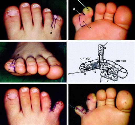 Anatomic Correction Of Polysyndactyly Of The Fifth Toe Fused With The