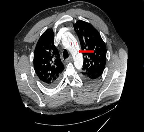 Painless Aortic Dissection In The Emergency Departmen