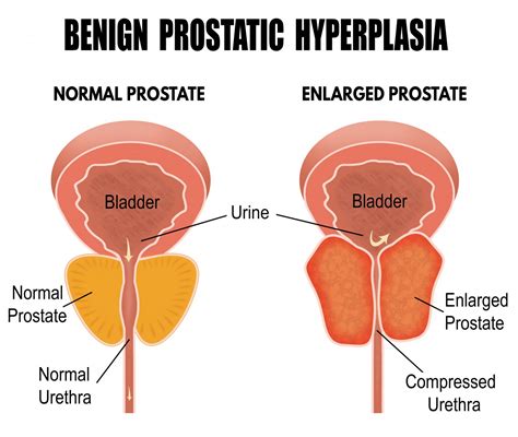 Enlarged Prostate What You Need To Know