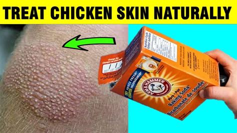 How To Remove Chicken Skin Underarms Naturally Keratosis Pilaris