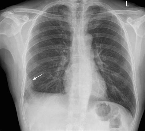 Een longembolie is een totale of gedeeltelijke inwendige afsluiting van één of meerdere tak(ken) van de arteria pulmonalis door met de bloedstroom meegevoerd materiaal, meestal een stolsel. Pulmonary Embolism (Haemodynamically Stable)