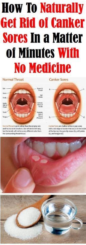 Canker Sores Are Referred To As Aphthous Ulcers And Are A Very Common