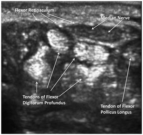 Sonographic Anatomy For Injection Of The Carpal Tunnel Download