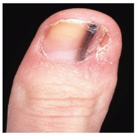 Squamous Cell Carcinoma And Melanoma Of The Hand Musculoskeletal Key