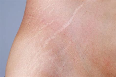 Red And White Stretch Marks Difference And Prevention Strategies Just