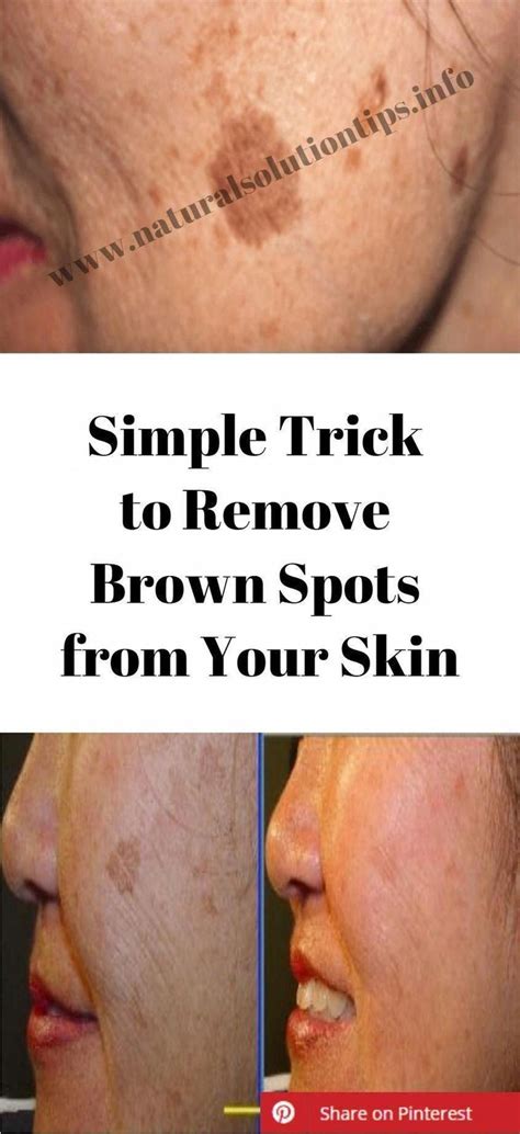 How You Can Take Away Brown Spots On Face