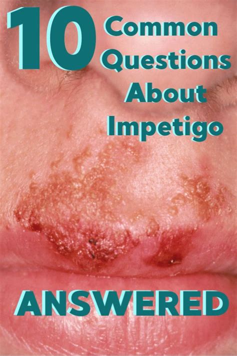 10 Impetigo Faqs And The Answers Health Sick Kids Healthy Skin