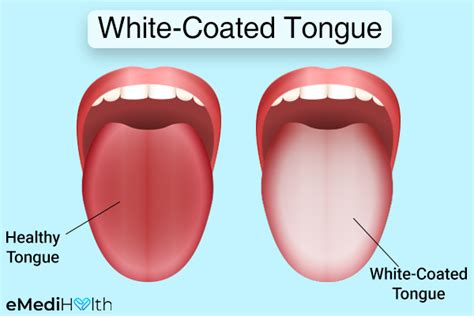 How To Identify White Tongue And Treat It Emedihealth