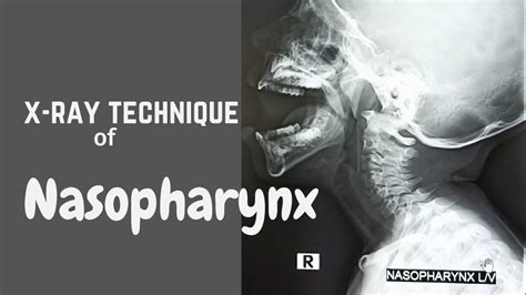Technique Of Nasopharynx Lateral View Ep 49 X Ray Soft Tissue