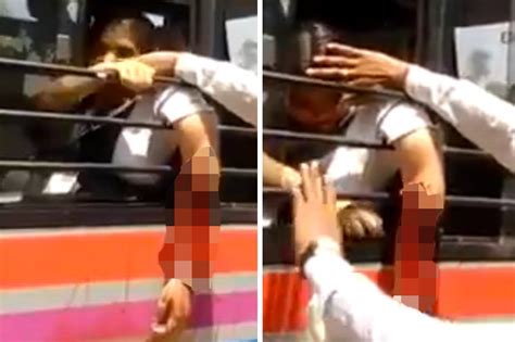 India School Girls Arm Ripped Off In Bus Accident In