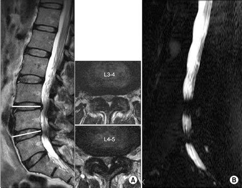 Effectiveness In Evaluating The Severity Of Stenosis In Mr Myelography