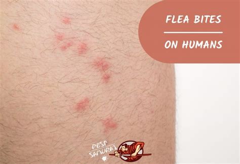 Flea Bites On Humans Identification Treatment Allergic Reactions More Pest Samurai