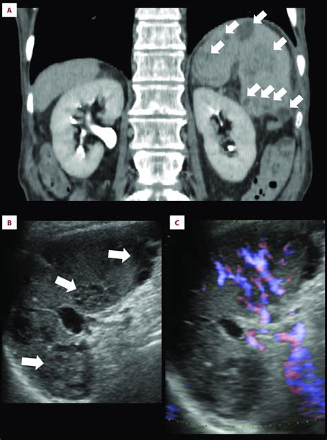 Images Of The Splenic Abscesses A Coronal Section Of Download
