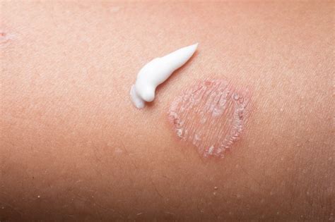 Fungal Skin Infections Faqs