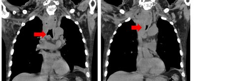 Different Approaches On Various Cases Of Tracheal Stenosis