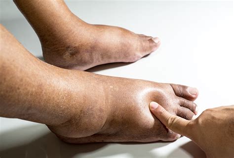 What Is Edema And How To Treat It EMediHealth