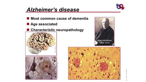 Wsdm Sex Differences In Alzheimers Disease Youtube