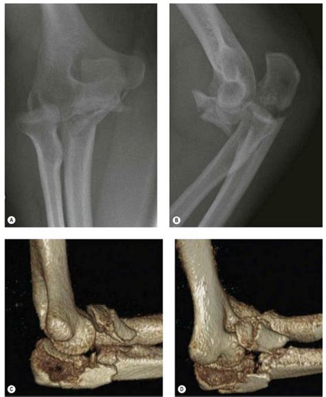 Filetype Ii Monteggia Fracture Dislocation A B The Radiographs Do