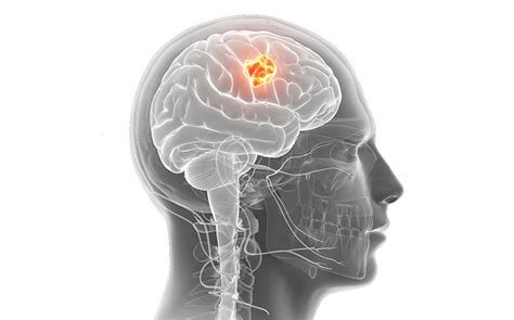 Brain Tumour Surgery Types Of Brain Tumours Risk Factor Sign