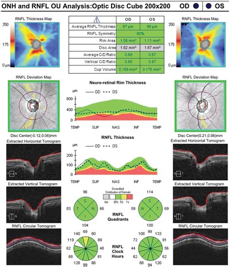 Role Of Sex In Retinal Nerve Fiber Layer And Macular Thickne Delta Journal Of Ophthalmology